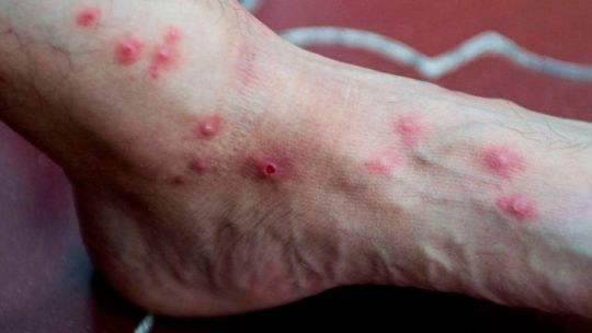 Confirman dos nuevos casos de viruela del mono en Córdoba: ya son seis los diagnósticos en la provincia